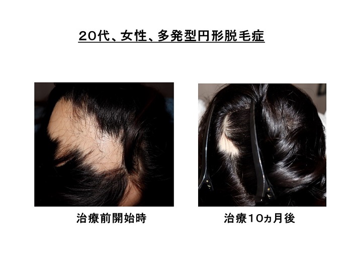 円形脱毛症　病院